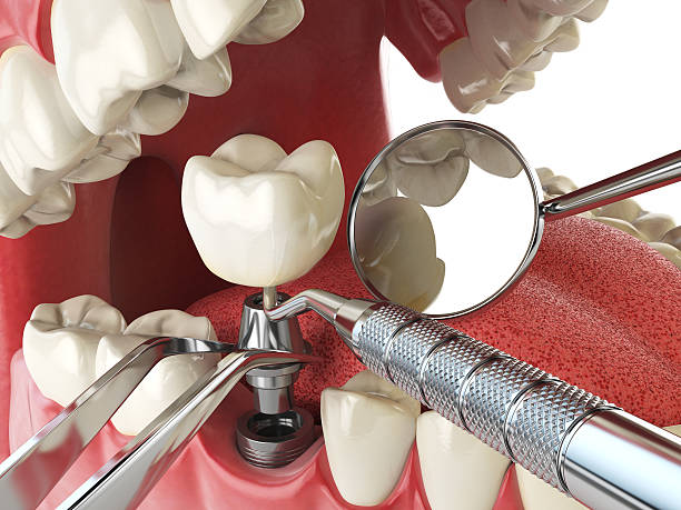 Best Emergency Denture Repair in Carbon Cliff, IL